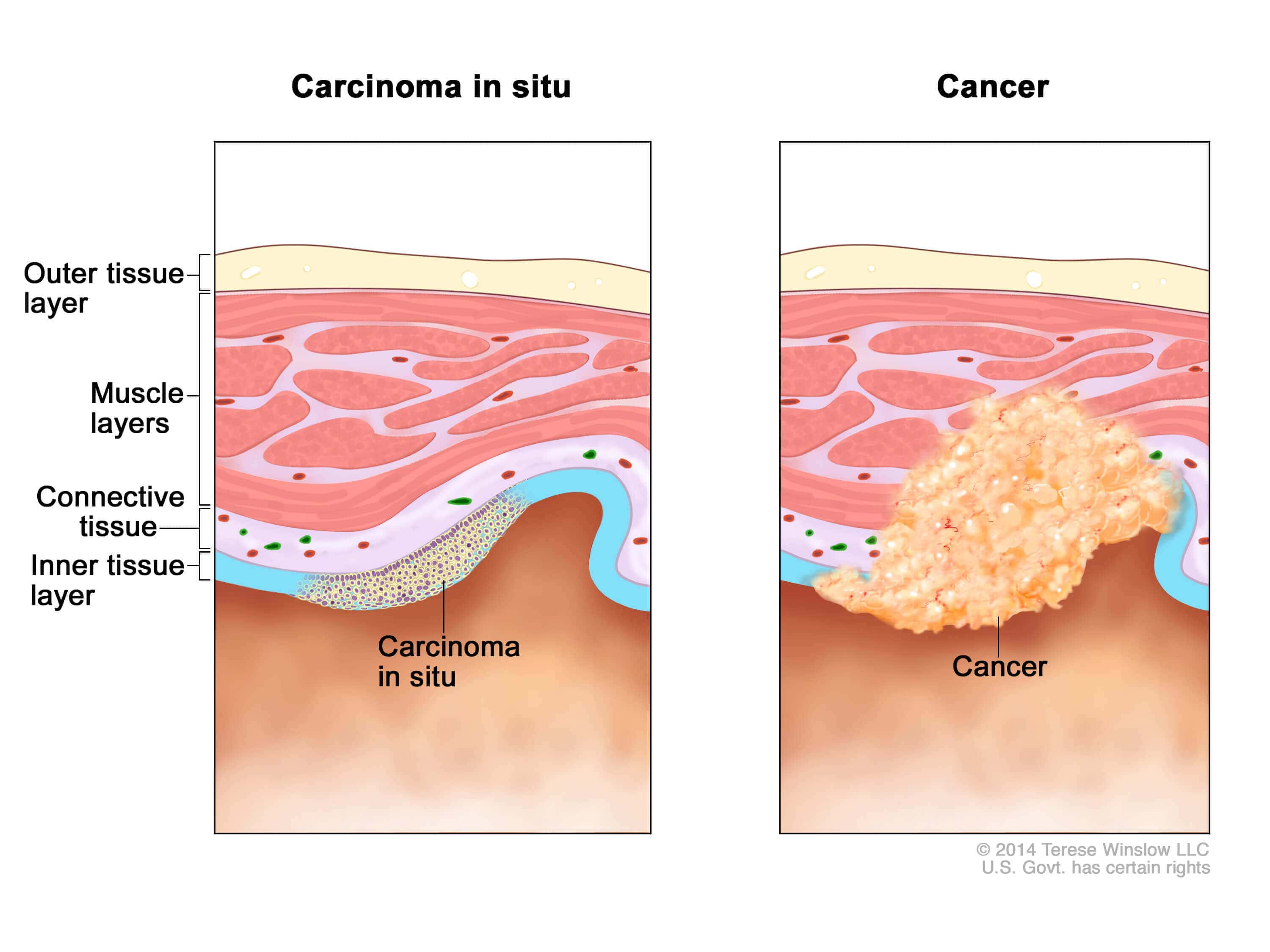 What Is A Sarcoma Cancer