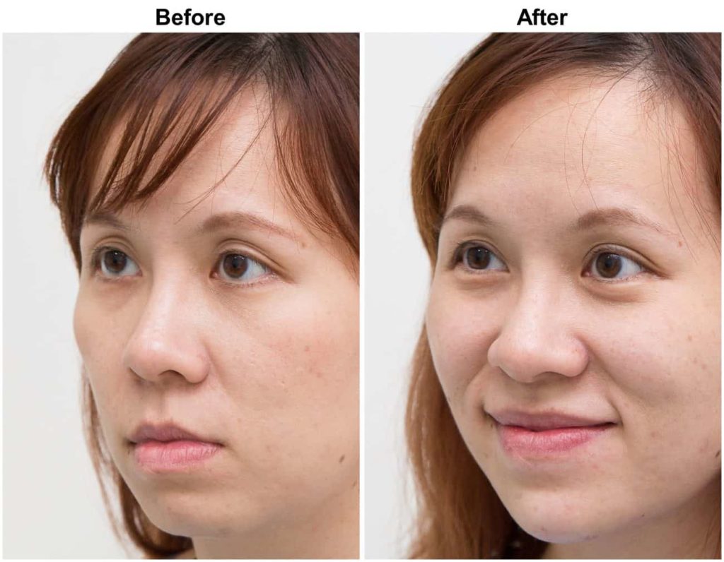 Defying Skin Aging with HIFU Facelift Treatment