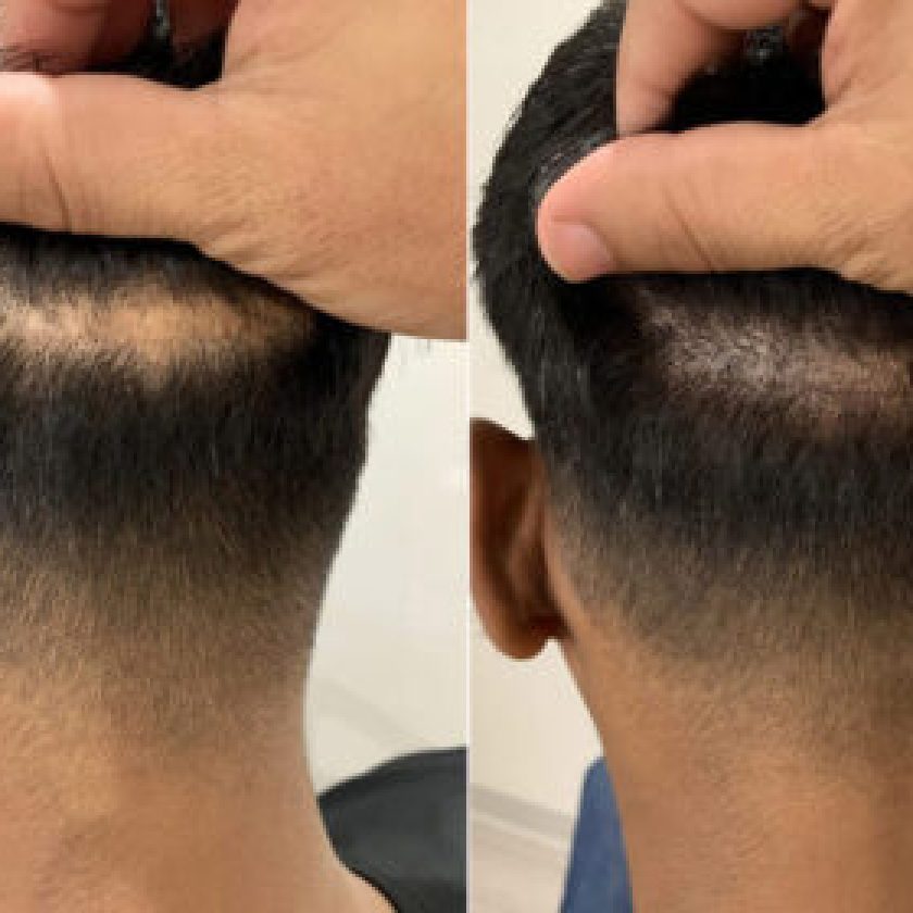 Micropigmentation vs Hair Transplants